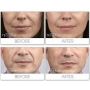 TEOSYAL PURESENSE ULTRA DEEP BEFORE AND AFTER