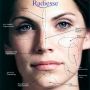 ZONES INJECTION RADIESSE