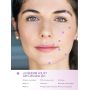 Zone di iniezione JUVEDERM VOLIFT