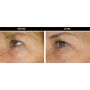 FILLMED M-HA 10 (3X3ml)