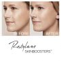 RESTYLANE VITAL LIGHT LIDO SKINBOOSTER (1x1ml) QMED