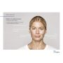 RESTYLANE INJECTION AREAS