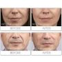10 TEOSYAL PURESENSE DEEP LINES (2x1ml) TEOXANE