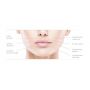 BELOTERO LIPS CONTOUR ZONE DI INIEZIONE