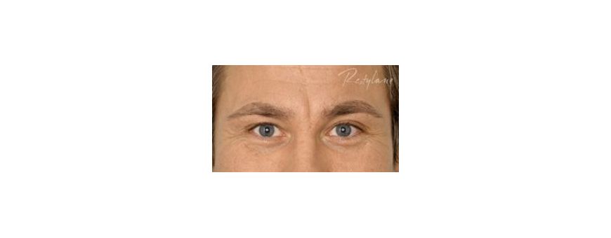 Hyaluronic Acid Injection | Anti wrinkle FROWN LINES - GLABELLAR