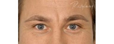 Hyaluronsäure-Injektion | ZORNESFALTEN Anti-Falten FILLER Hyaluronsäure-Injektion | ZORNESFALTEN Anti-Falten FILLER