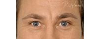 GLABELLA