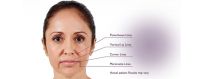 Aesthetic Hyaluronic acid injection | Filling of the NASOLABIAL FOLDS