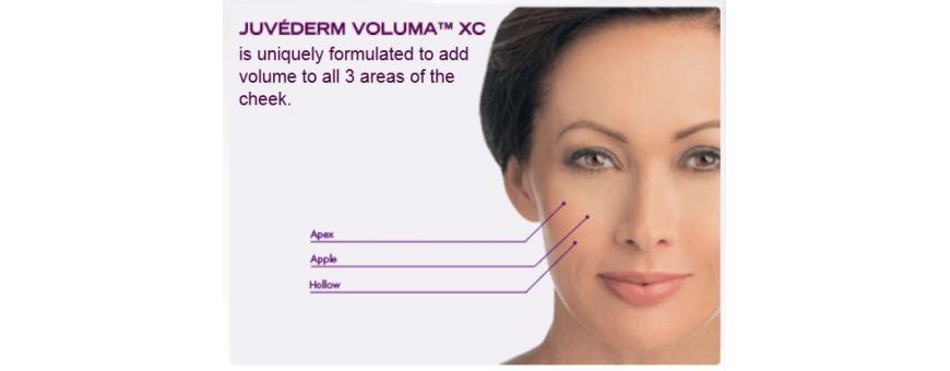 Hyaluronic acid filler Injection | CHEEKS - CHEEKBONES - TEMPLES