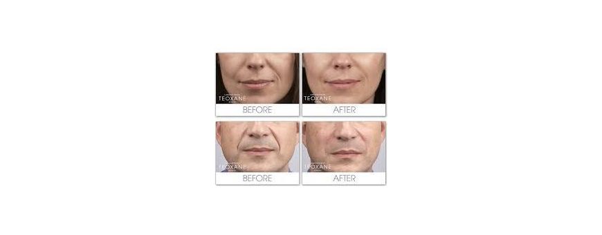 Aesthetic Hyaluronic acid injection FILLER | Wrinkle MARIONETTE LINES