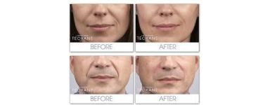 Inyección estética ácido hialurónico FILLER | LINEAS DE MARIONETA Inyección estética ácido hialurónico FILLER | LINEAS DE MARIONETA