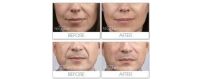 Aesthetic Hyaluronic acid injection FILLER | Wrinkle MARIONETTE LINES