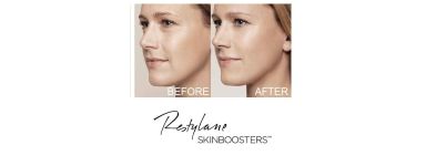 ACIDO IALURONICO SKINBOOSTER | Idratante. Luminosità, compattezza ACIDO IALURONICO SKINBOOSTER | Idratante. Luminosità, compattezza